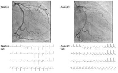 Outpatient Management of Patients With Angina With No Obstructive Coronary Arteries: How to Come to a Proper Diagnosis and Therapy